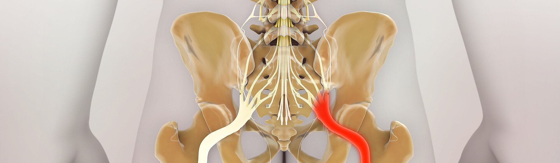 Ischialgie_Ischiasschmerz_Nerv_unterer_Rücken