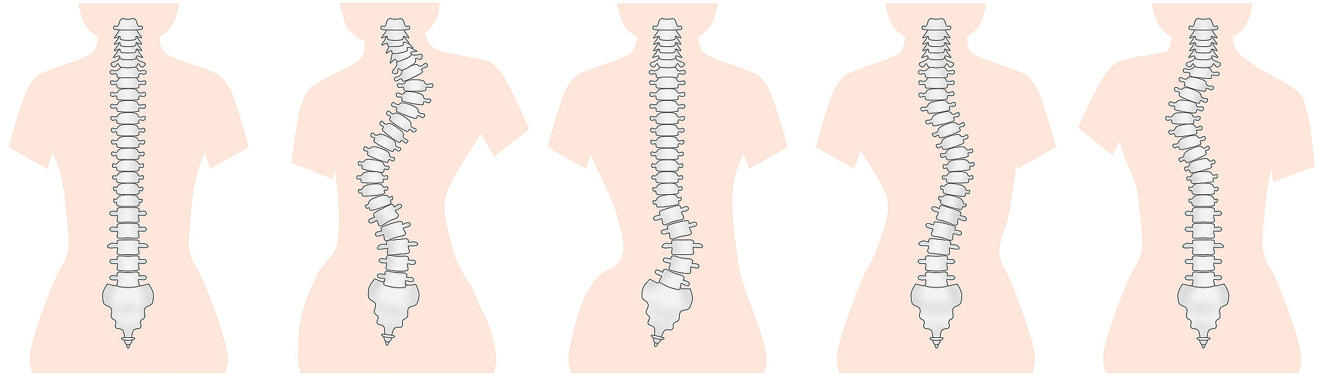 Scoliosis_spinal_curvature_instability_spine_special_clinic_spine_center